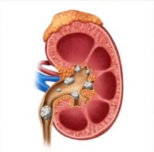 kidney stone treatment in Delhi