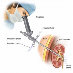 kidney stone treatment in Vaishali