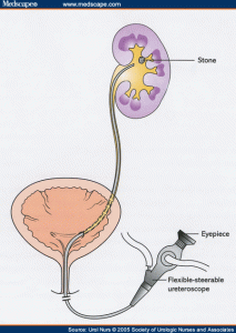 kidney stone treatment in East Delhi