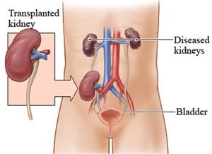 Kidney Transplant Surgeon in Noida