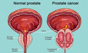 Kidney Transplant Surgeon in Noida